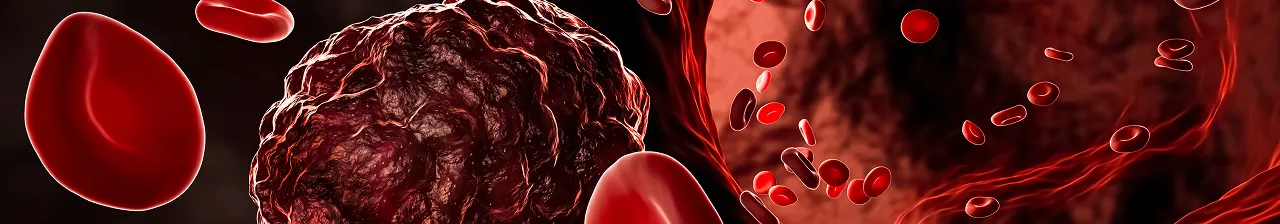 Visuel illustrant l'article MTEV et Cancer sur Acoplus
