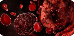 Visuel illustrant l'article MTEV et Cancer sur Acoplus